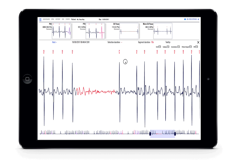 ECG Monitoring